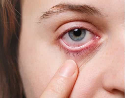 Conjuntivitis alérgicas Alergolog Málaga