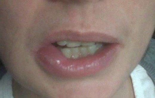 Alergias en la piel Angioedema Alergologo Malaga