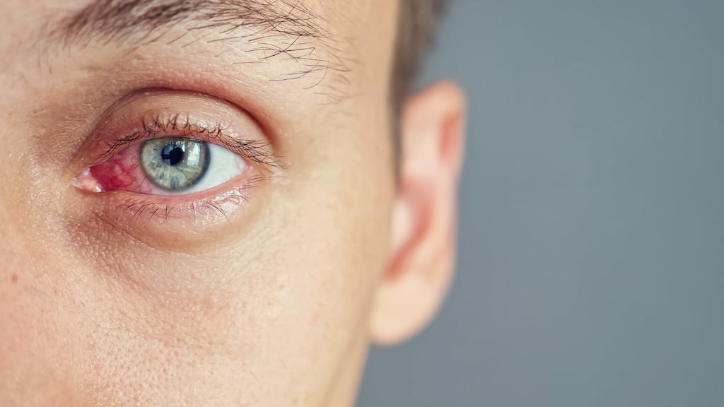 conjuntivitis alérgica tratamiento